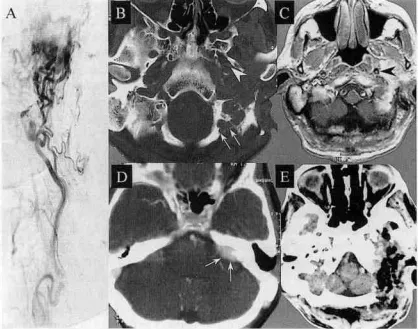 A，术前左颈内动脉造影显示高度血管化的肿瘤。B，术前CT扫描上的箭头显示肿瘤侵蚀区域位于枕骨髁下的枕骨大孔内侧缘，而箭头指向颈内动脉