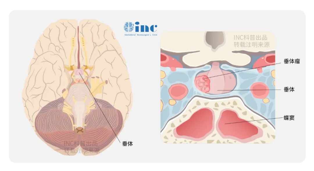 垂体瘤图片