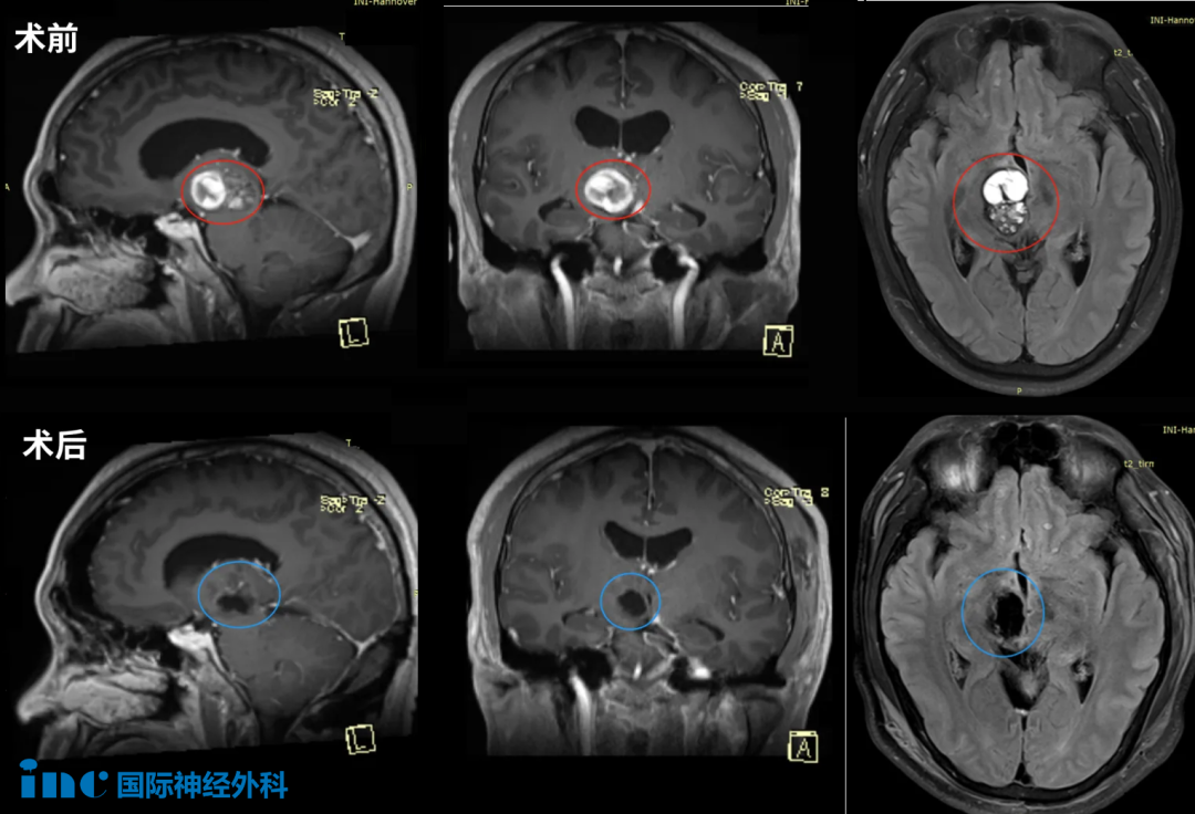 38岁陈先生-脑干中脑海绵状血管瘤