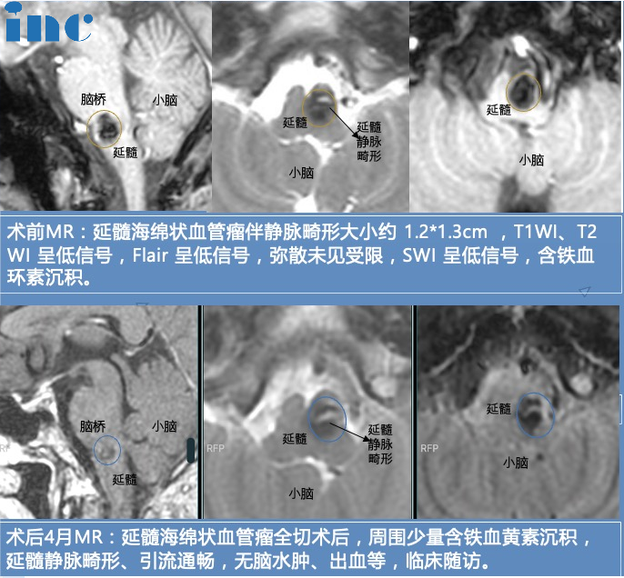 32岁男性-脑干延髓海绵状血管瘤