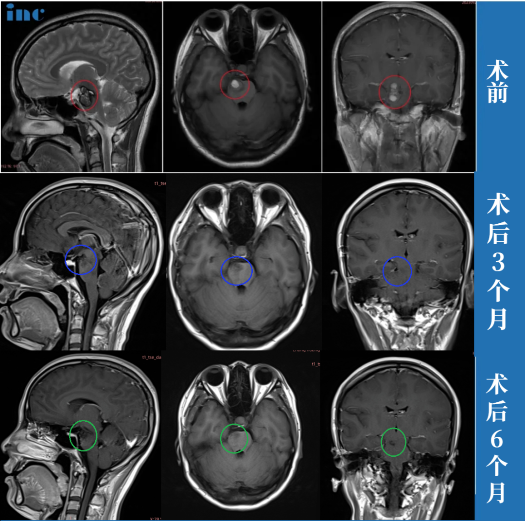 30岁女士-脑干中脑及桥脑海绵状血管瘤