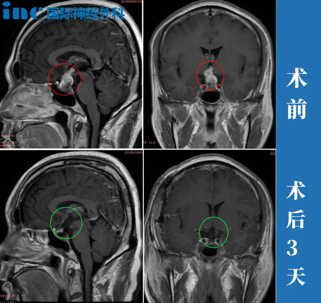 颅咽管瘤手术可以全切吗？是否可以完整保留垂体柄？