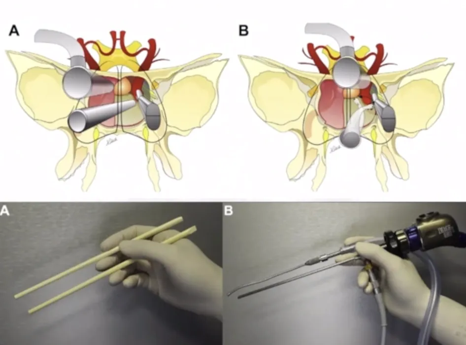 福教授手术技术总结——单鼻孔“筷子技术”