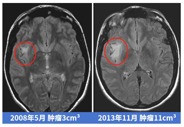 肿瘤发展进程变化