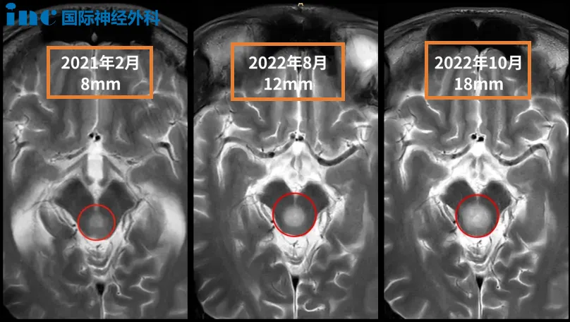 21岁男性-脑干低级别胶质瘤，2个月迅速生长8mm