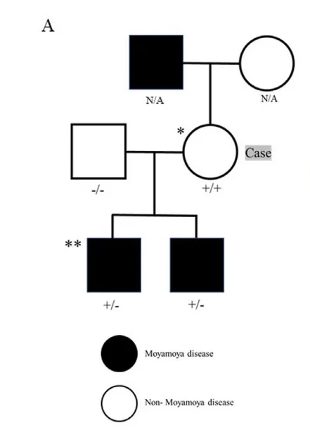 她的2个孩子和叔叔有典型的烟雾病和RNF213p。R4810K杂合子变异，均进行了血运重建术。