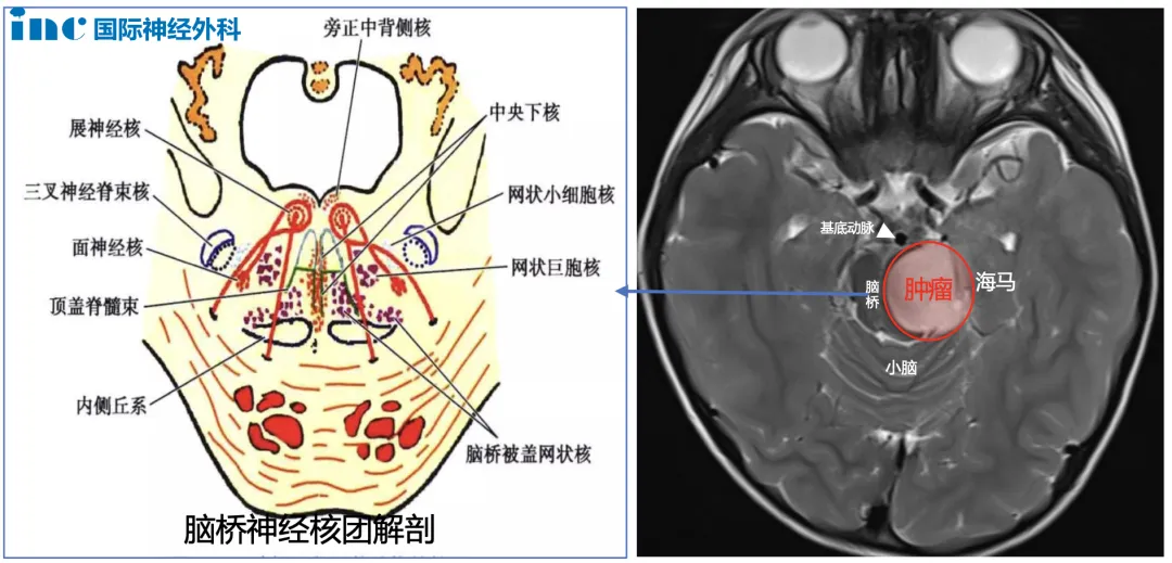 儿童脑干胶质瘤