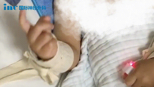 北京天坛医院手术纪实——母子连心战胜脑干胶质瘤，全家人的开心果又回来啦！