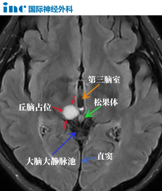 丘<a href='/naoliu/' target='_blank'><u>脑肿瘤</u></a>