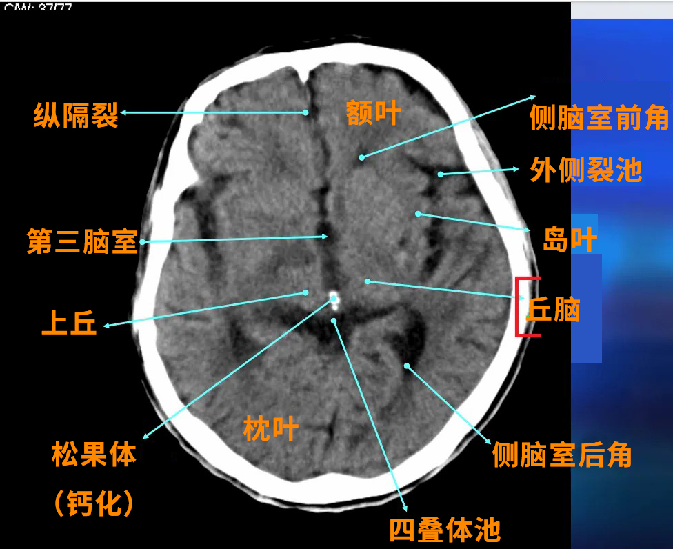 丘脑附近重要的邻居有松果体、下丘脑、中脑。