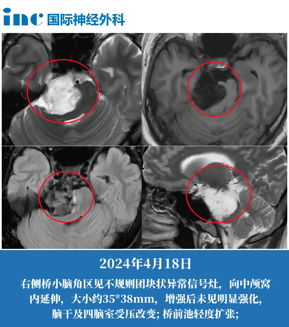 29岁男性-右侧桥小脑角区占位