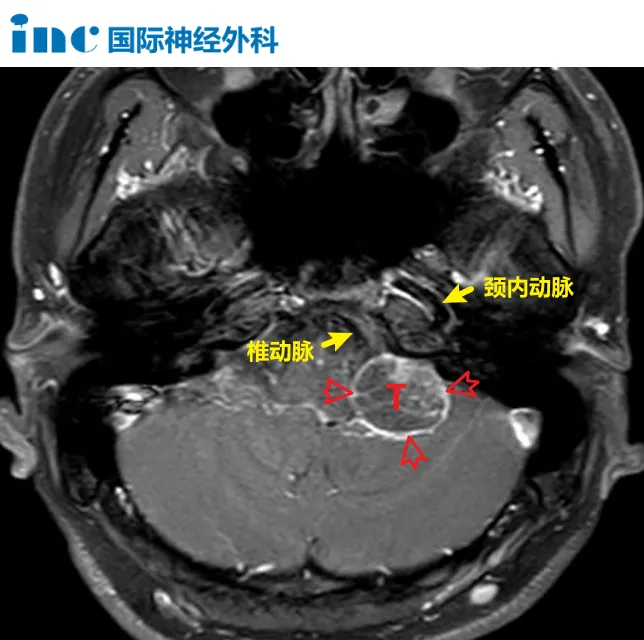 颈静脉孔区肿瘤