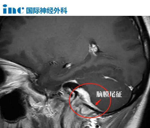 39岁女性-颈静脉孔区脑膜瘤图片