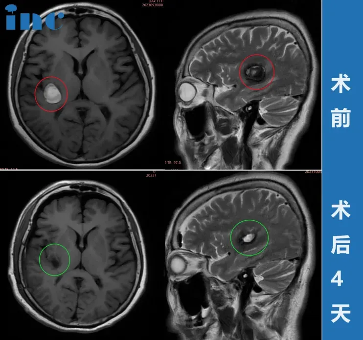 37岁女性—脑干海绵状血管瘤