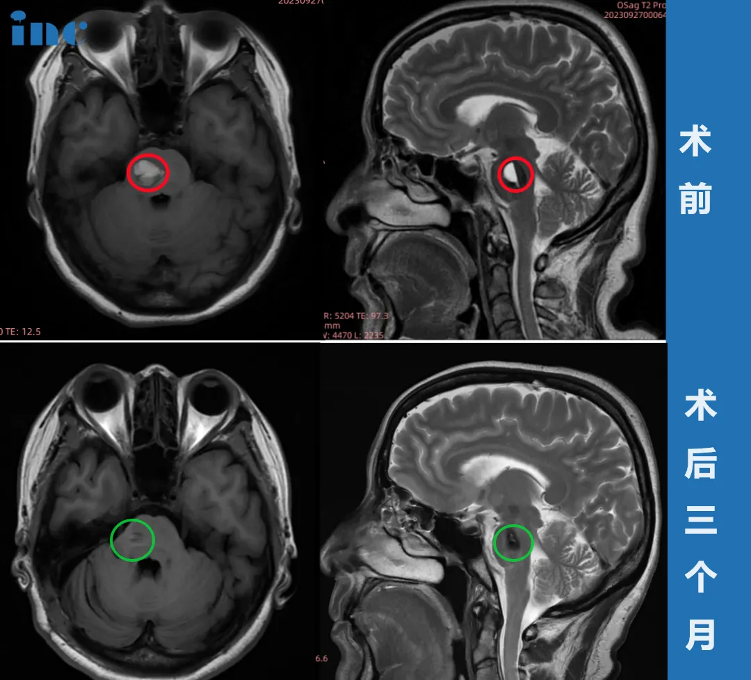 52岁女性—脑干海绵状血管瘤
