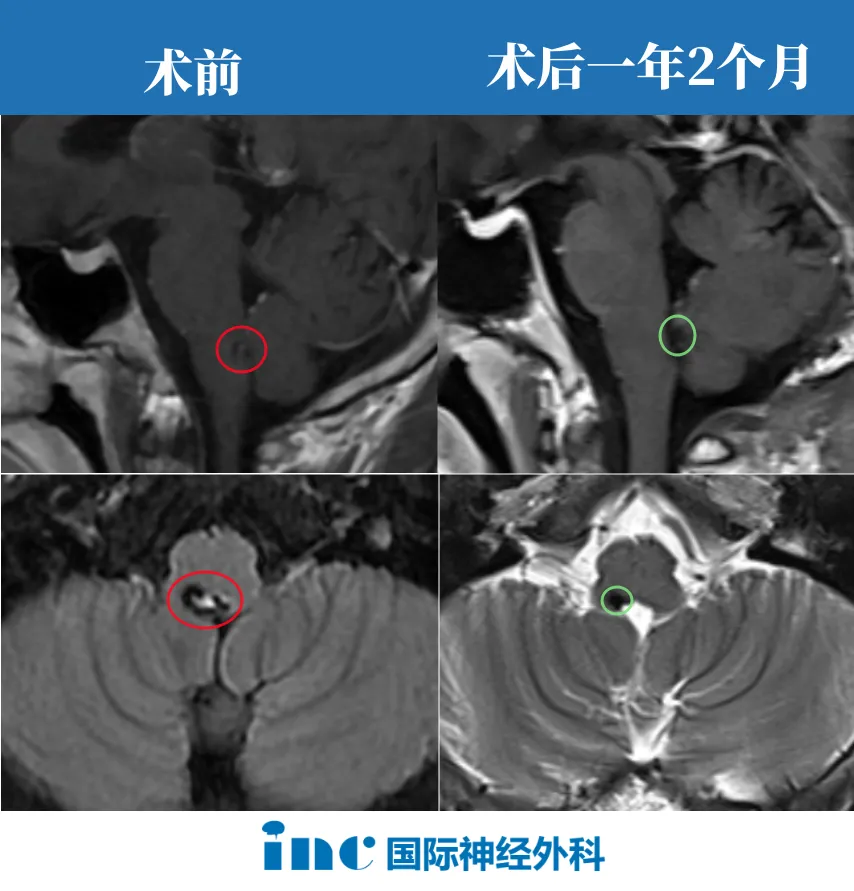 脑干海绵状血管瘤成功案例