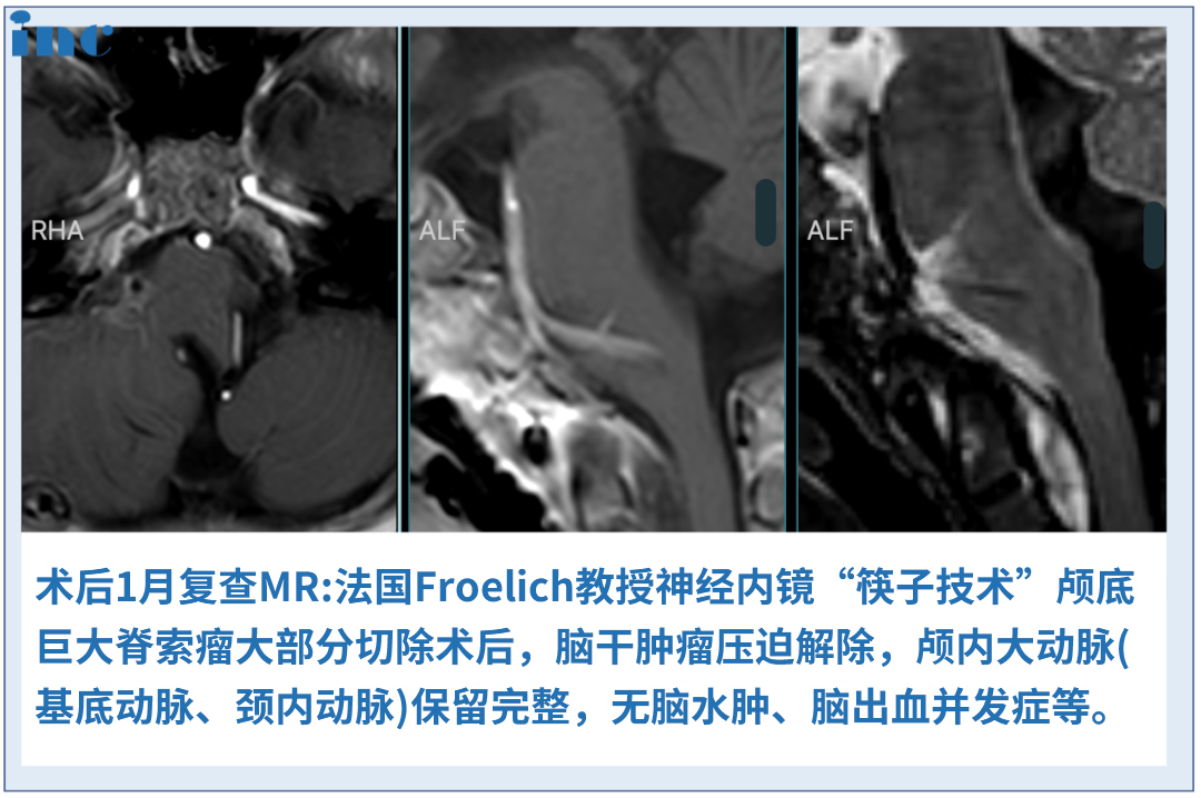 较大脊索瘤案例