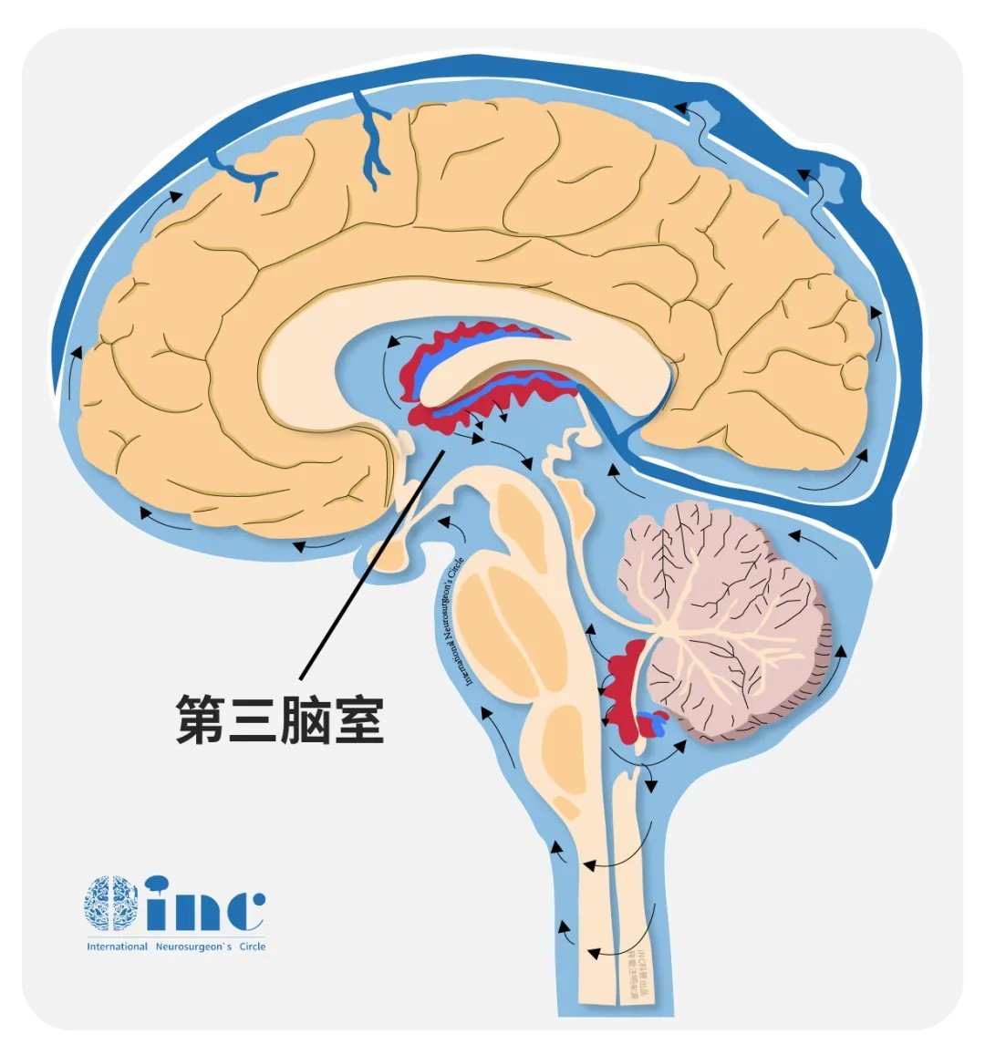 什么是脑脊液漏
