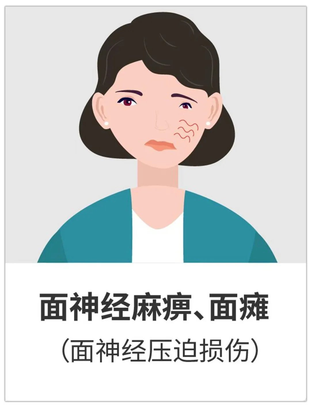面瘫