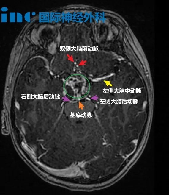 7岁男孩-鞍上区囊实性占位疑似颅咽管瘤。一次摔倒，竟然“摔”出脑肿瘤