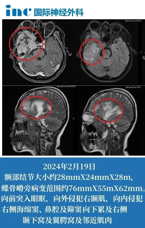 42岁女性-右侧颞部、蝶骨嵴旁脑膜瘤复发