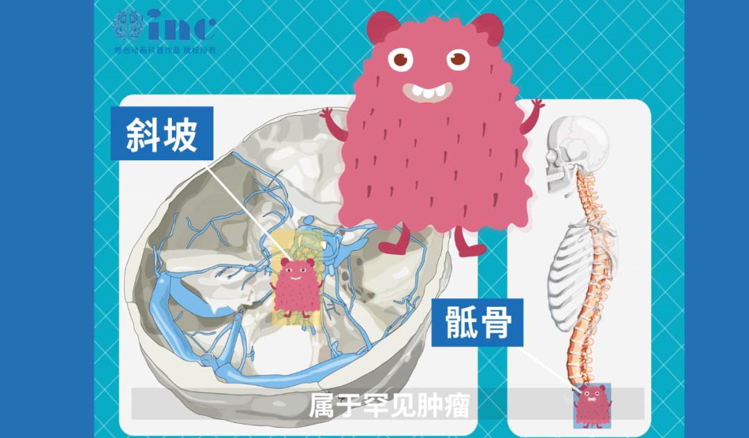什么是骶骨脊索瘤？