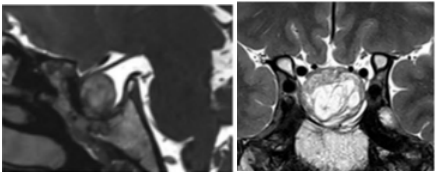 图4：术后一年MRI