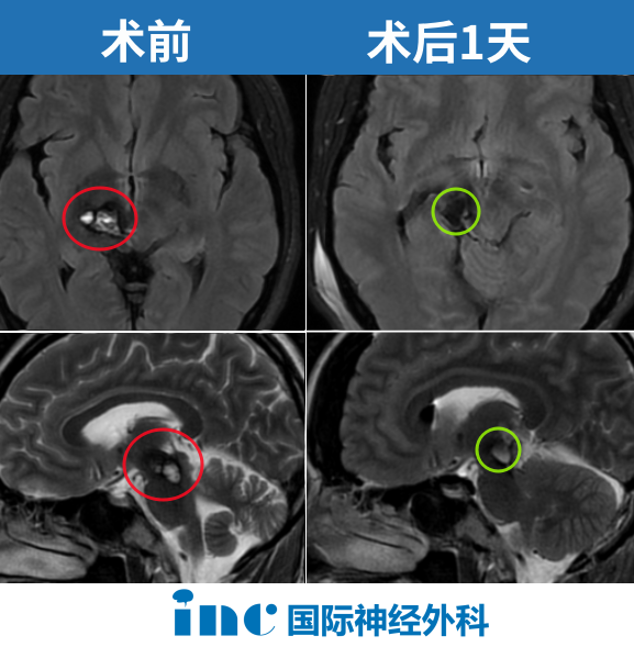 术前术后影像