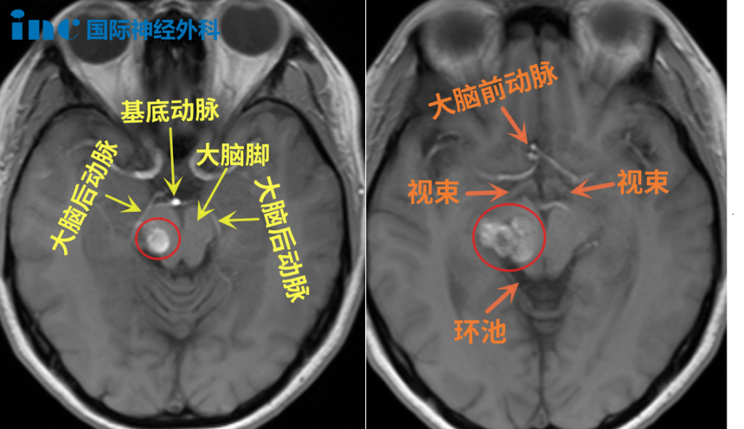 病灶位于丘脑等重要功能区，周边毗邻大脑后动脉、基底动脉、大脑前动脉、视束等重要结构