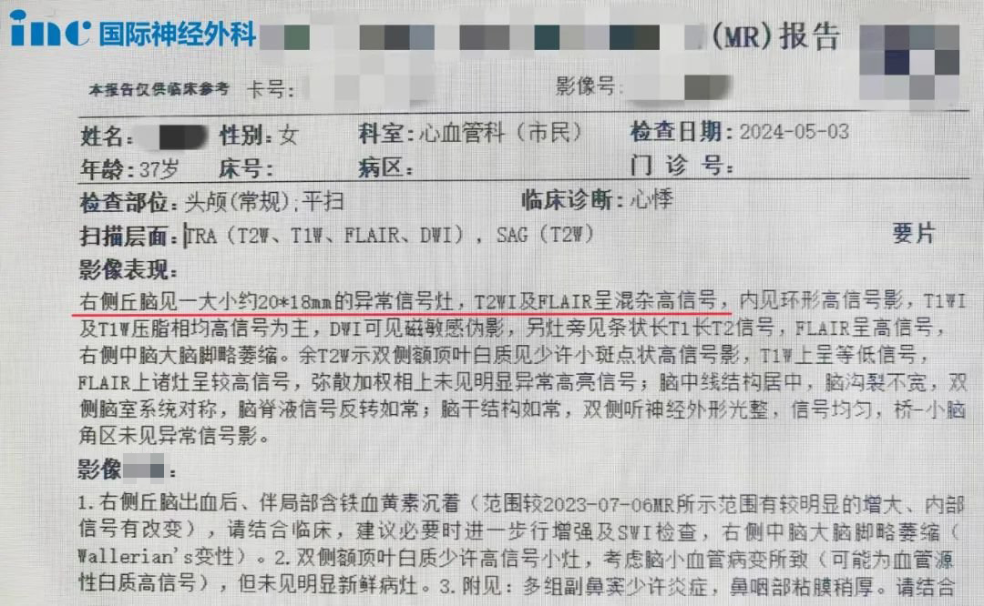 海绵状血管瘤