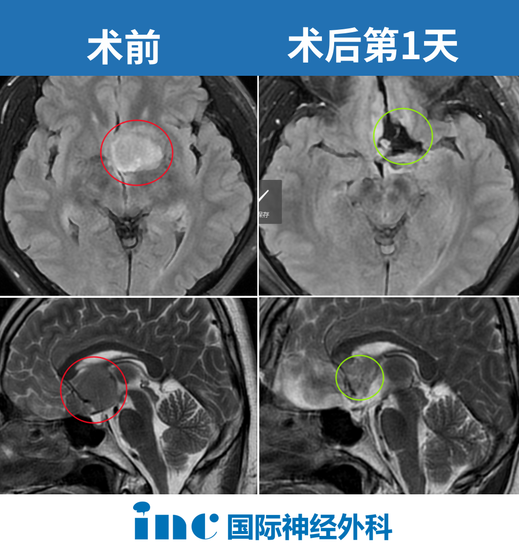 术后肿瘤切除达到预期，并且神经功能保护得很好，无任何新发神经功能损伤
