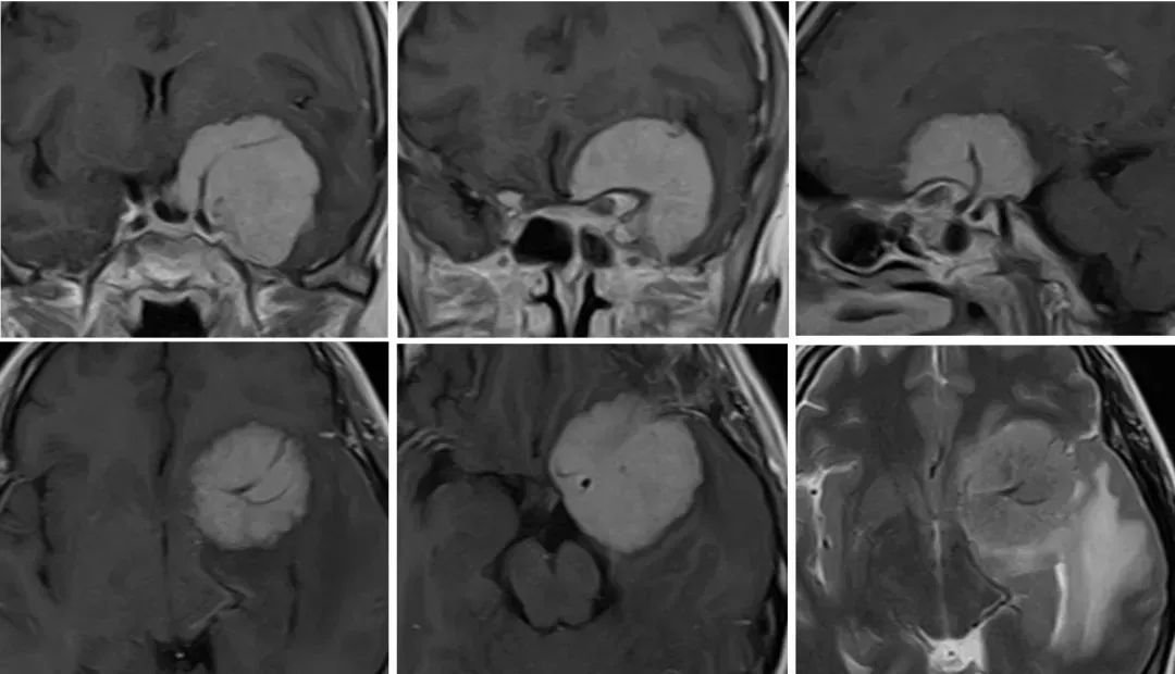 文献支持使用完整的术前神经放射学检查，包括MRI、CT扫描、CTA和/或MRA。高质量的T2和T1成像技术(CISS和VIBE)可用于增加视神经管和海绵窦内肿瘤扩展的可视化。在目前的实践中，可以在选定的情况下考虑DSA。(C级)