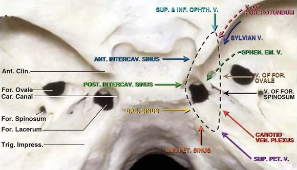 在这种情况下，肿瘤可以横向延伸到海绵窦或向后延伸到后床突和岩斜区。
