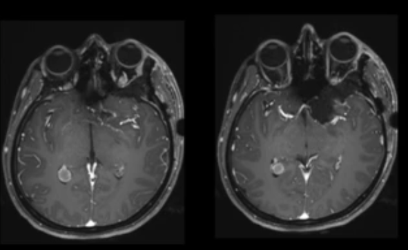 术后MRI