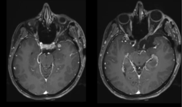 术后MRI