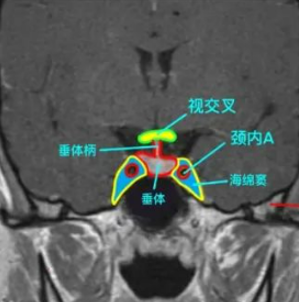 患者通常表现为邻近结构的局部肿块效应症状(是视交叉)