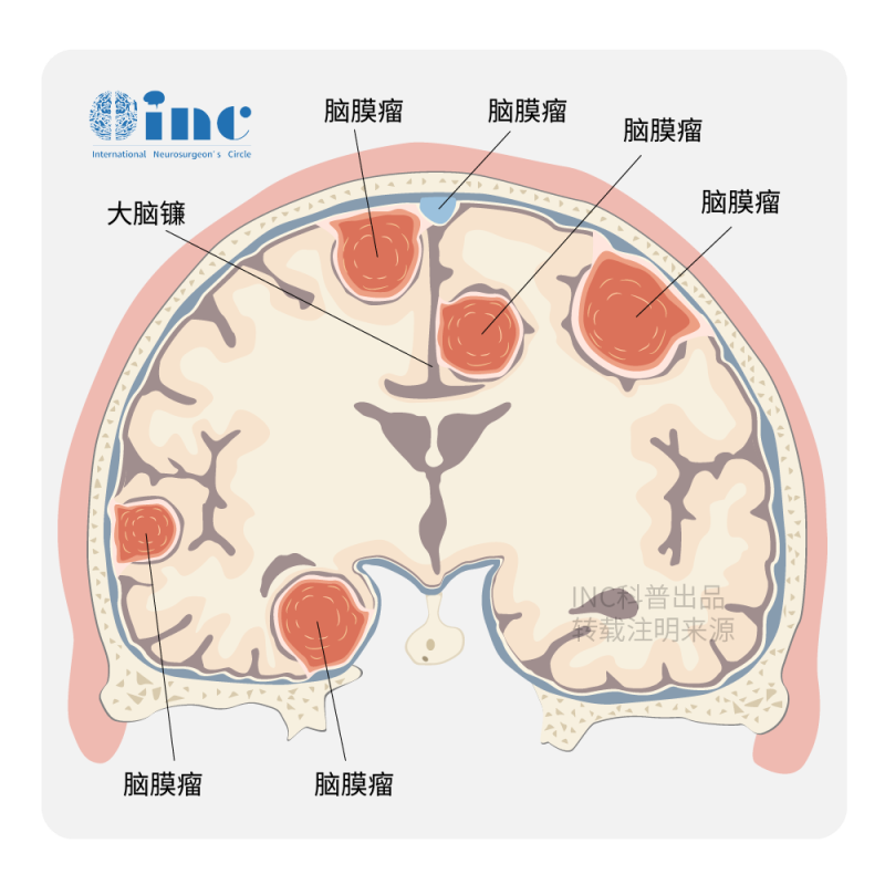 恶性脑膜瘤是怎么引起的?一般长在什么位置?