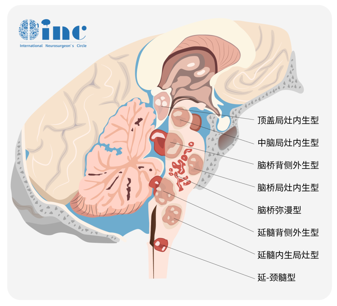 发生于胼胝体、三脑室、丘脑、脑干等中线结构的高级别脑胶质瘤——弥漫中线胶质瘤