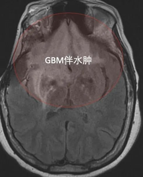▼高信号，颅内多发病灶，双侧额叶广泛病变,越过中线，累及胼胝体。