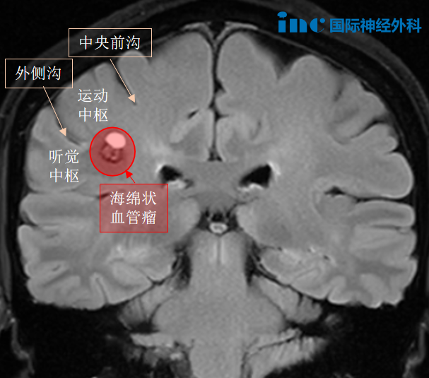 经历过一次出血、病灶小，为何她会果断选择手术？