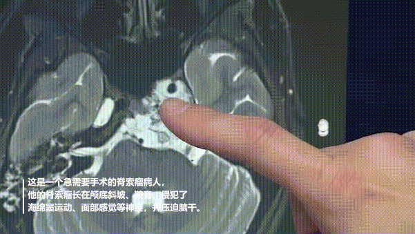 福教授在术前分析患者影像资料，指出肿瘤所在位置及周边重要脑组织及结构。