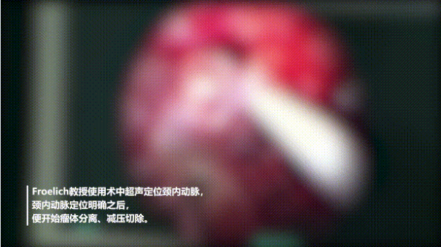术中超声定位颈内动脉，颈内动脉定位明确之后，便开始瘤体分离、减压切除。而后，他开始切除基底动脉及脑干边的肿瘤，并注意小心分离血管，注意保护脑干等关键结构