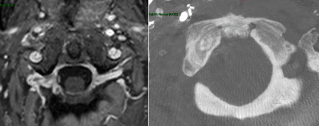 术后MRI：成功切除严重压迫脑干腹侧的斜坡较大脊索瘤，实现镜下全切。
