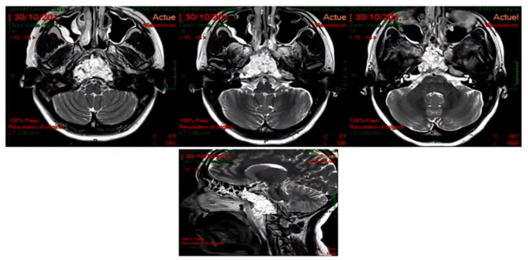 这是术后的MRI，高信号的是脂肪组织。