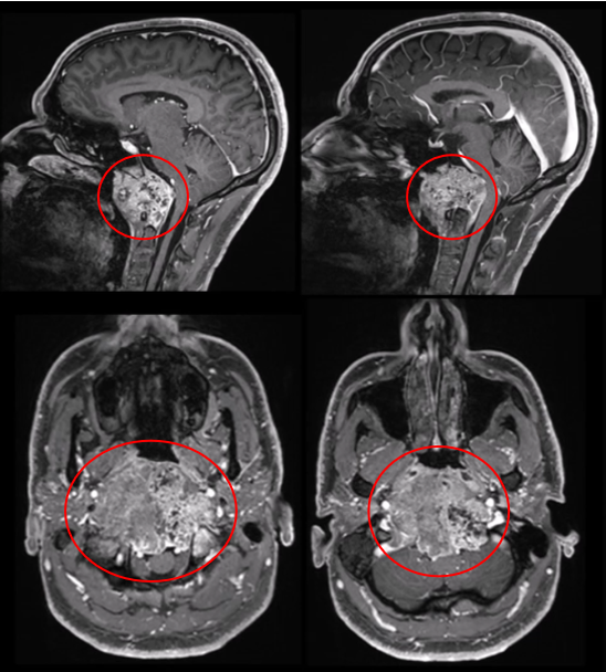 术前MRI，较大颅颈交界区脊索瘤，肿瘤较大直径达10cm、瘤体积96.5cm³，肿瘤并向双后外侧延伸浸润性生长，