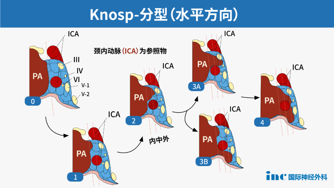 表1.垂体腺瘤改良Knosp分级