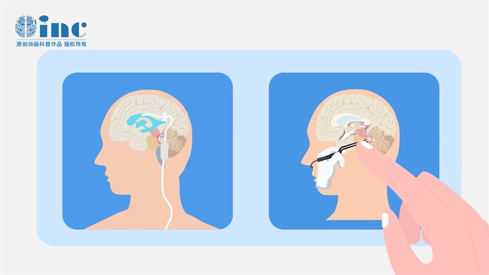颅内胆脂瘤一般多大需要手术?做手术对面部有影响吗?