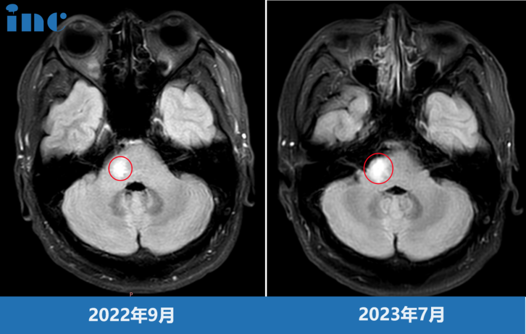 点击韩先生术前影像，阅读完整患者故事