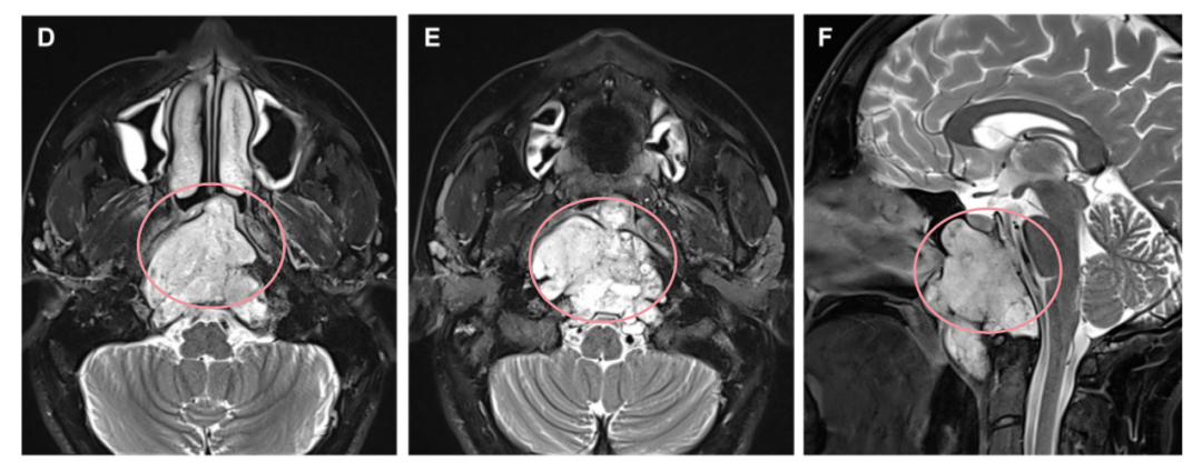 D、E术前轴向和F矢状 t2加权MRI