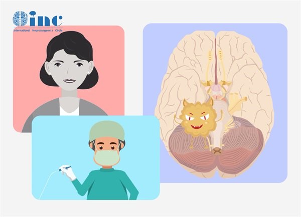 脑干胶质瘤活检方法是什么?活检成功率高吗?